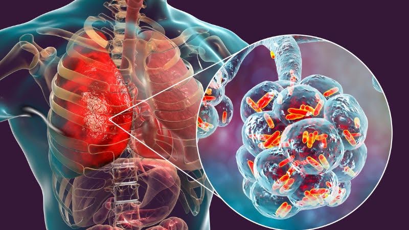 Respiratory Infections